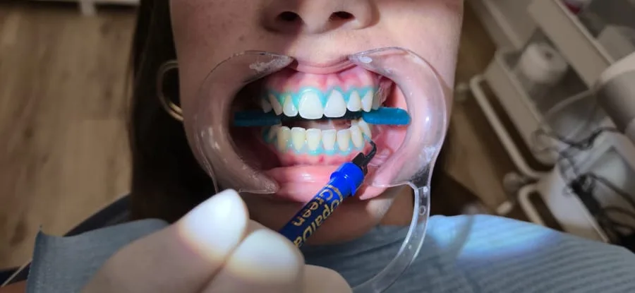 Blanqueamiento dental